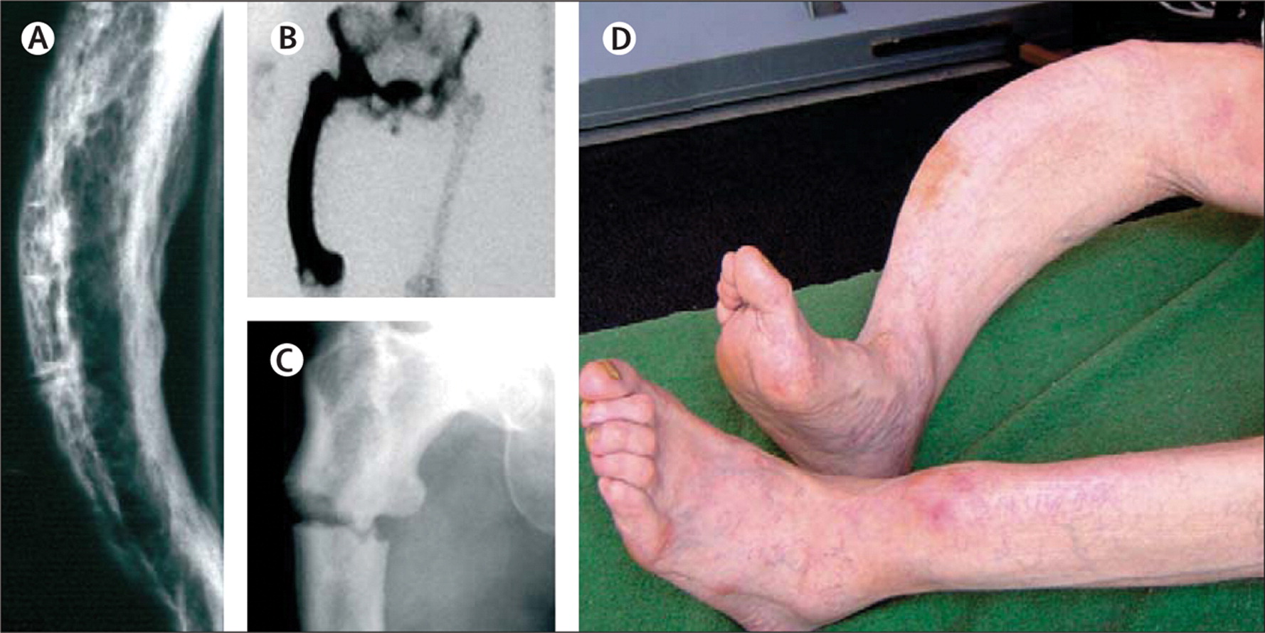 25-facts-about-paget-disease-juvenile-type