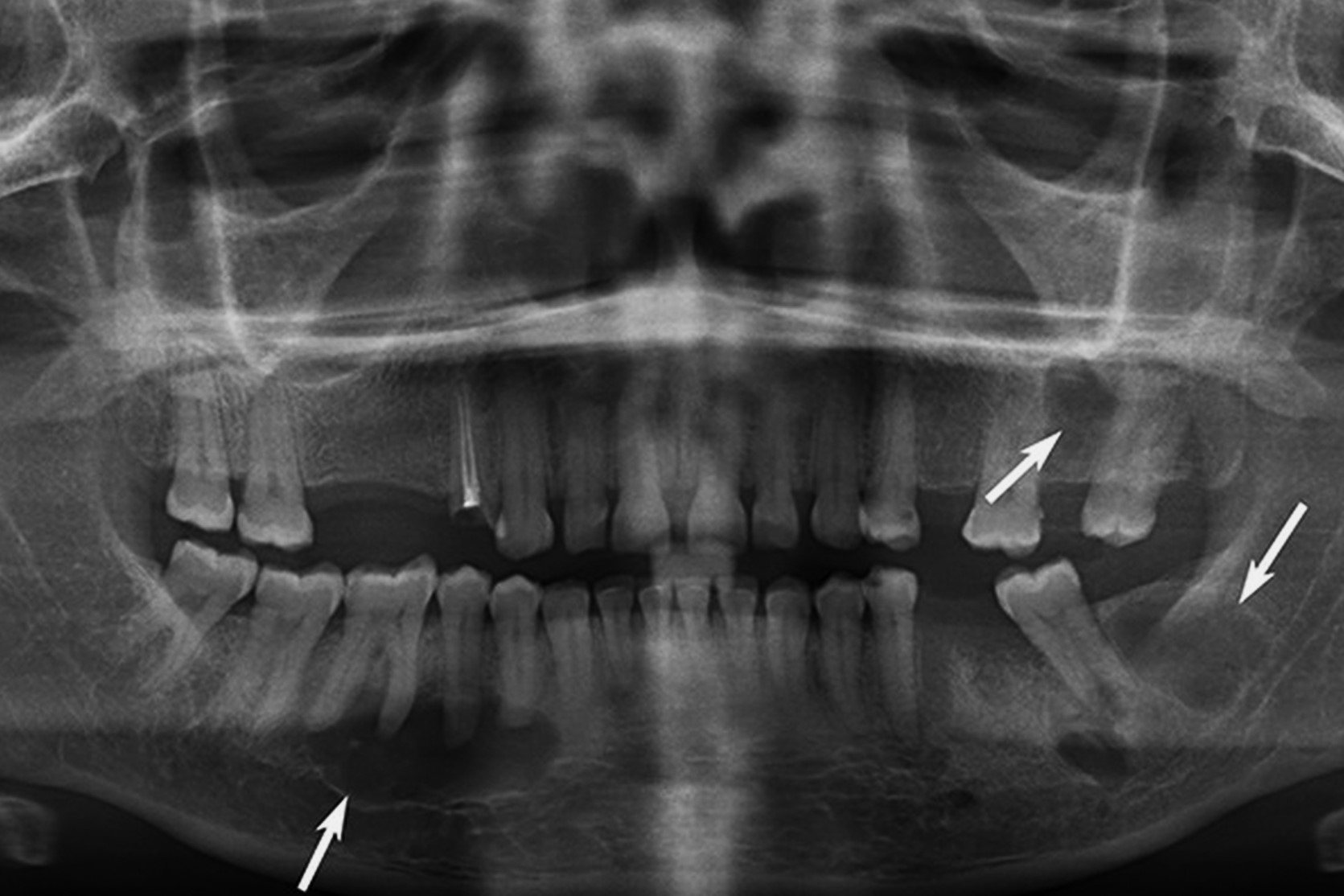 25-facts-about-panostotic-fibrous-dysplasia