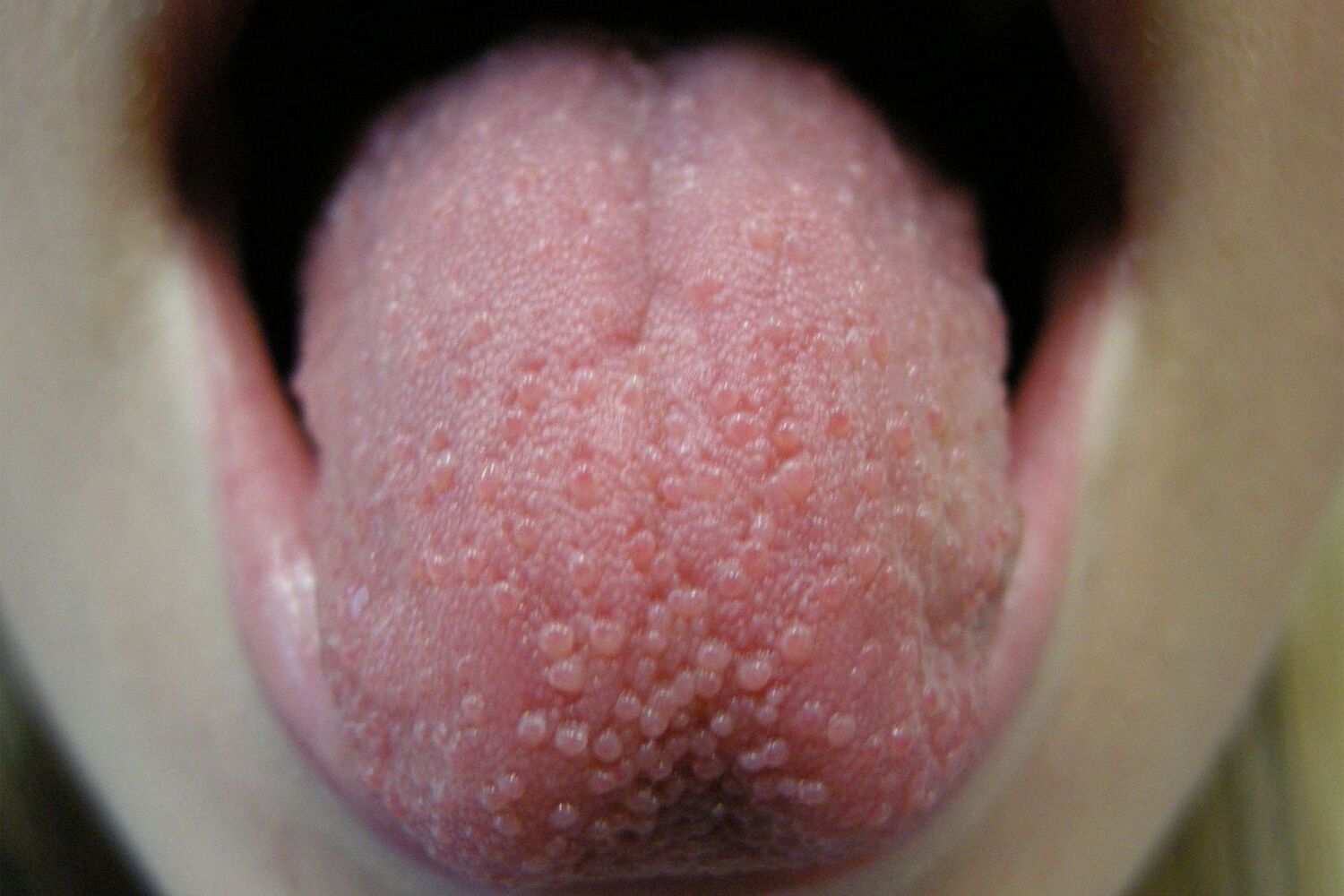 25-facts-about-papillitis-of-the-lingual-papillae