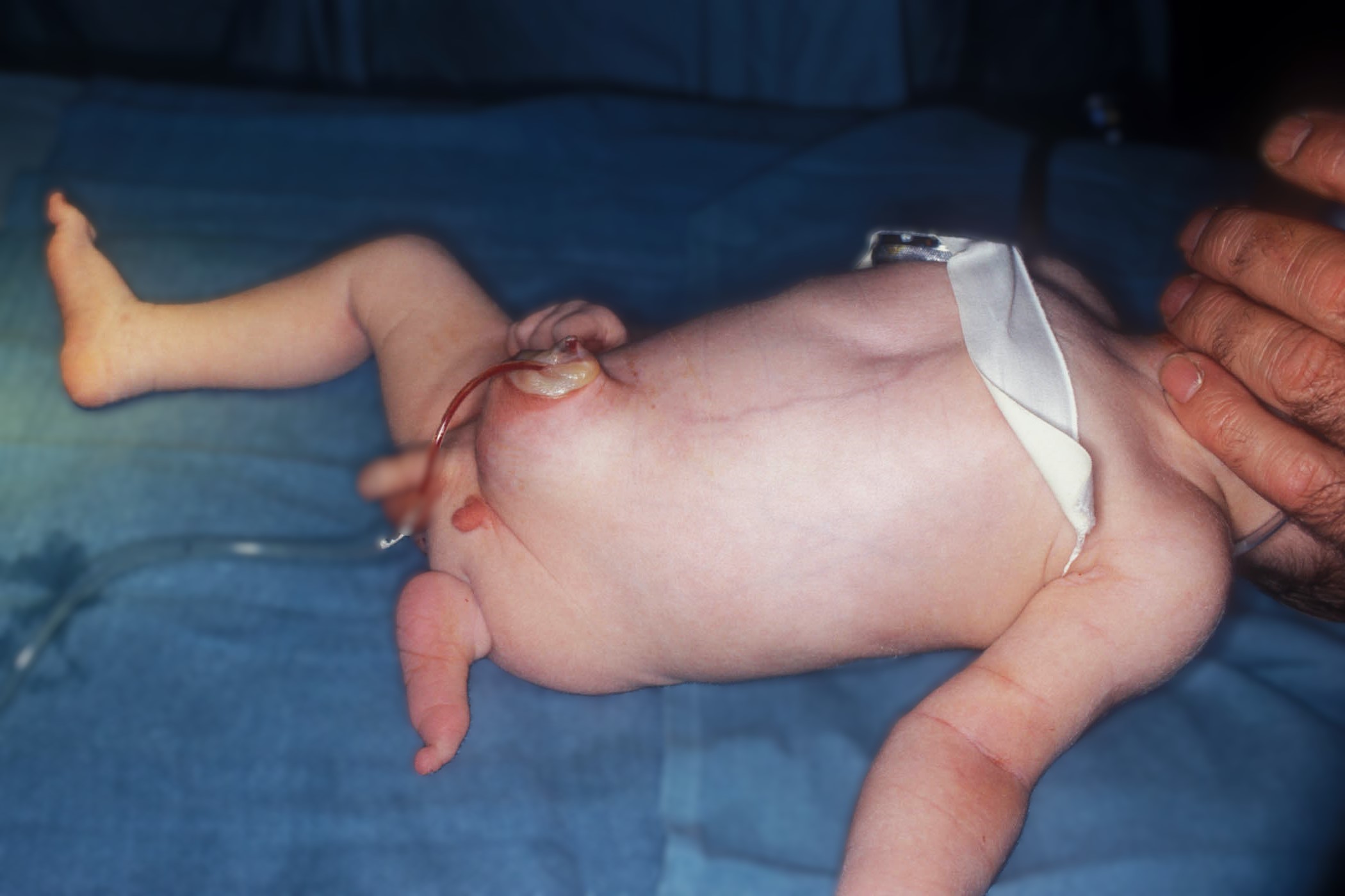 25-facts-about-paraomphalocele