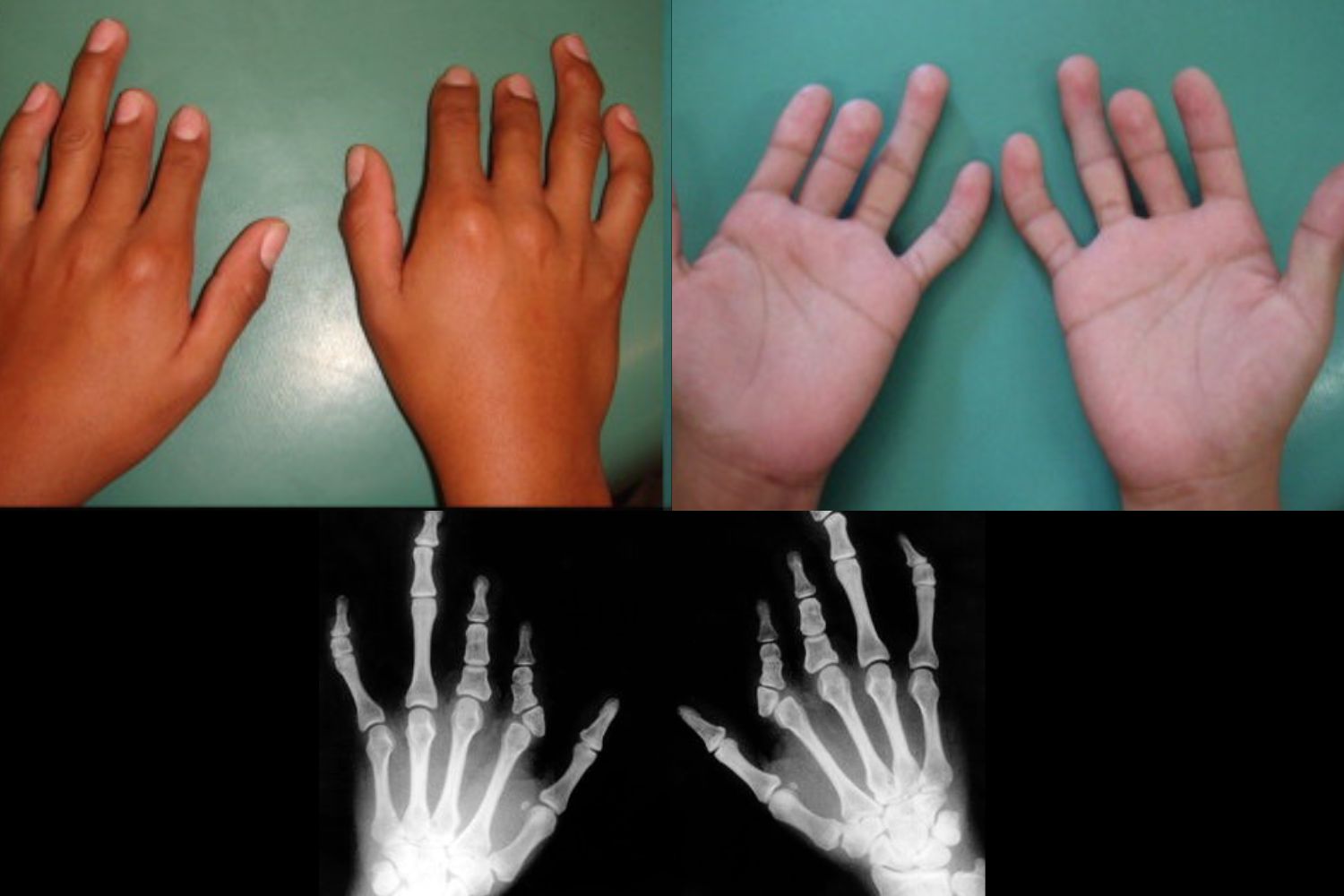 25-facts-about-paraplegia-brachydactyly-cone-shaped-epiphysis