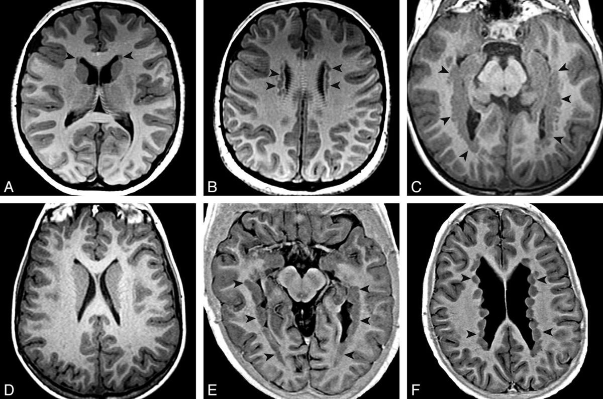 25-facts-about-periventricular-laminar-heterotopia