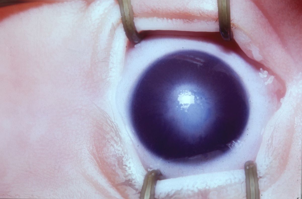 25-facts-about-peters-anomaly-with-cataract