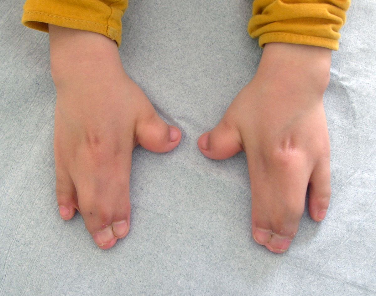 25-facts-about-pfeiffer-type-acrocephalosyndactyly