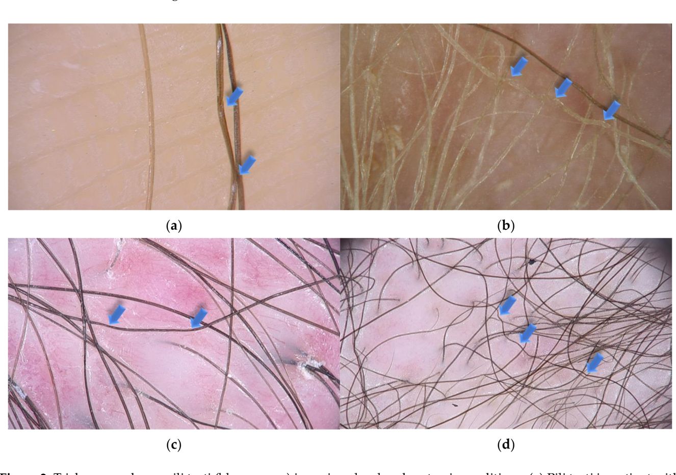 25 Facts About Pili Torti Nerve Deafness - Facts.net