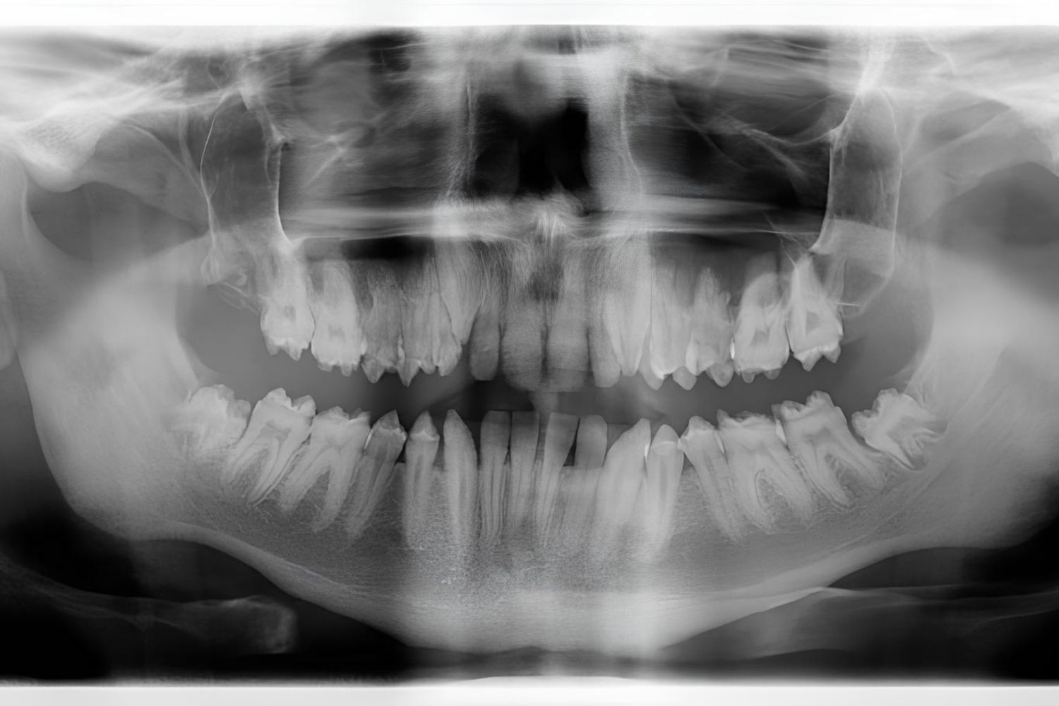 25-facts-about-platyspondyly-amelogenesis-imperfecta