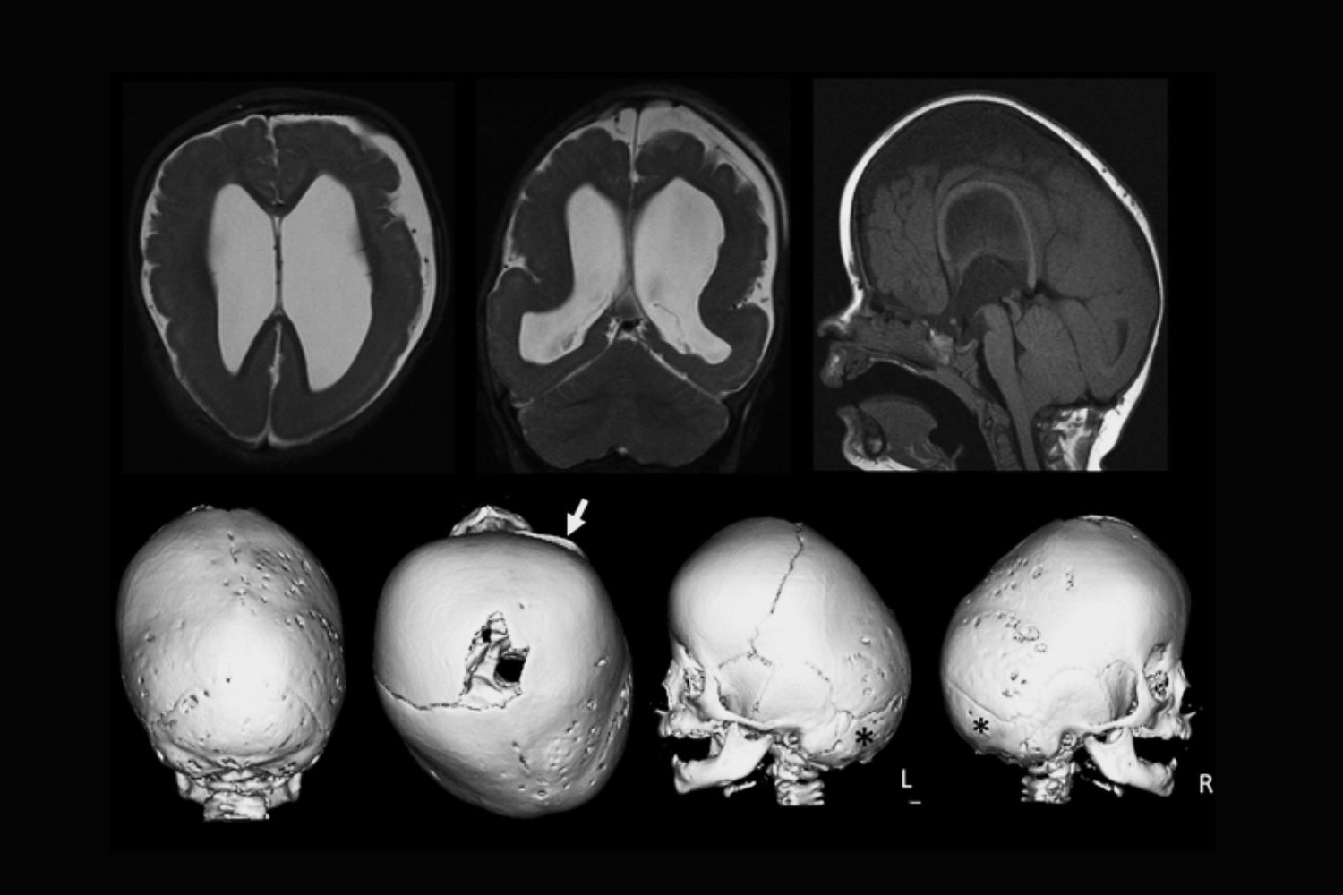 25-facts-about-polymicrogyria-turricephaly-hypogenitalism