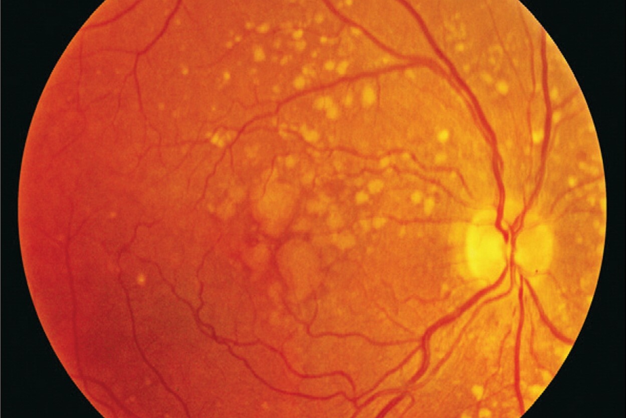 25-facts-about-polymorphic-macular-degeneration