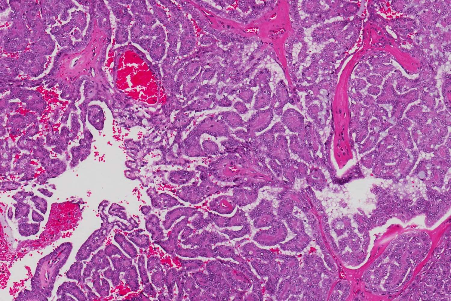 25-facts-about-polymorphous-low-grade-adenocarcinoma