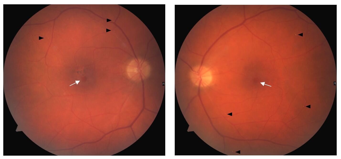 25-facts-about-retinal-telangiectasia-hypogammaglobulinemia