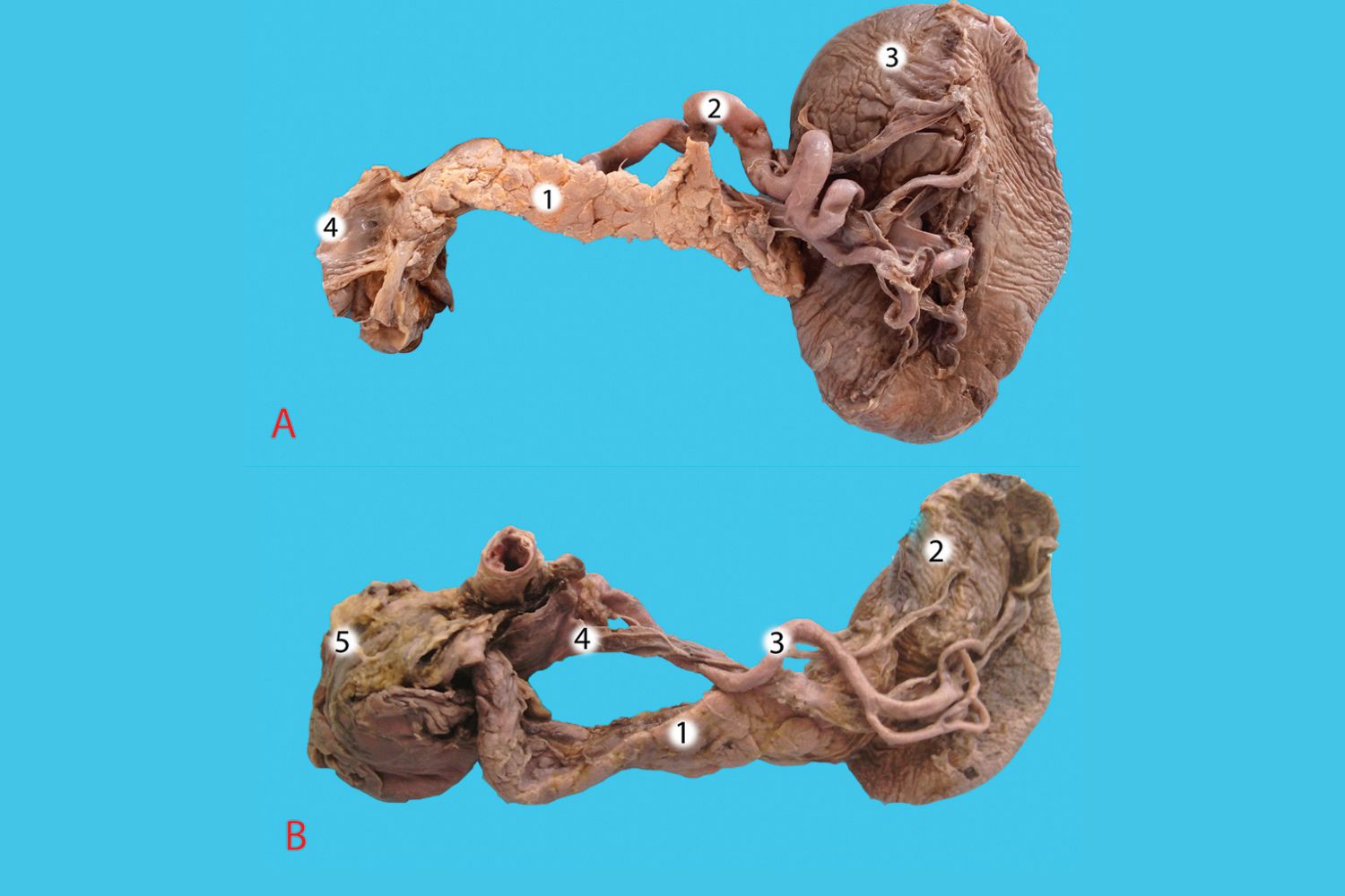 25-facts-about-splenic-agenesis