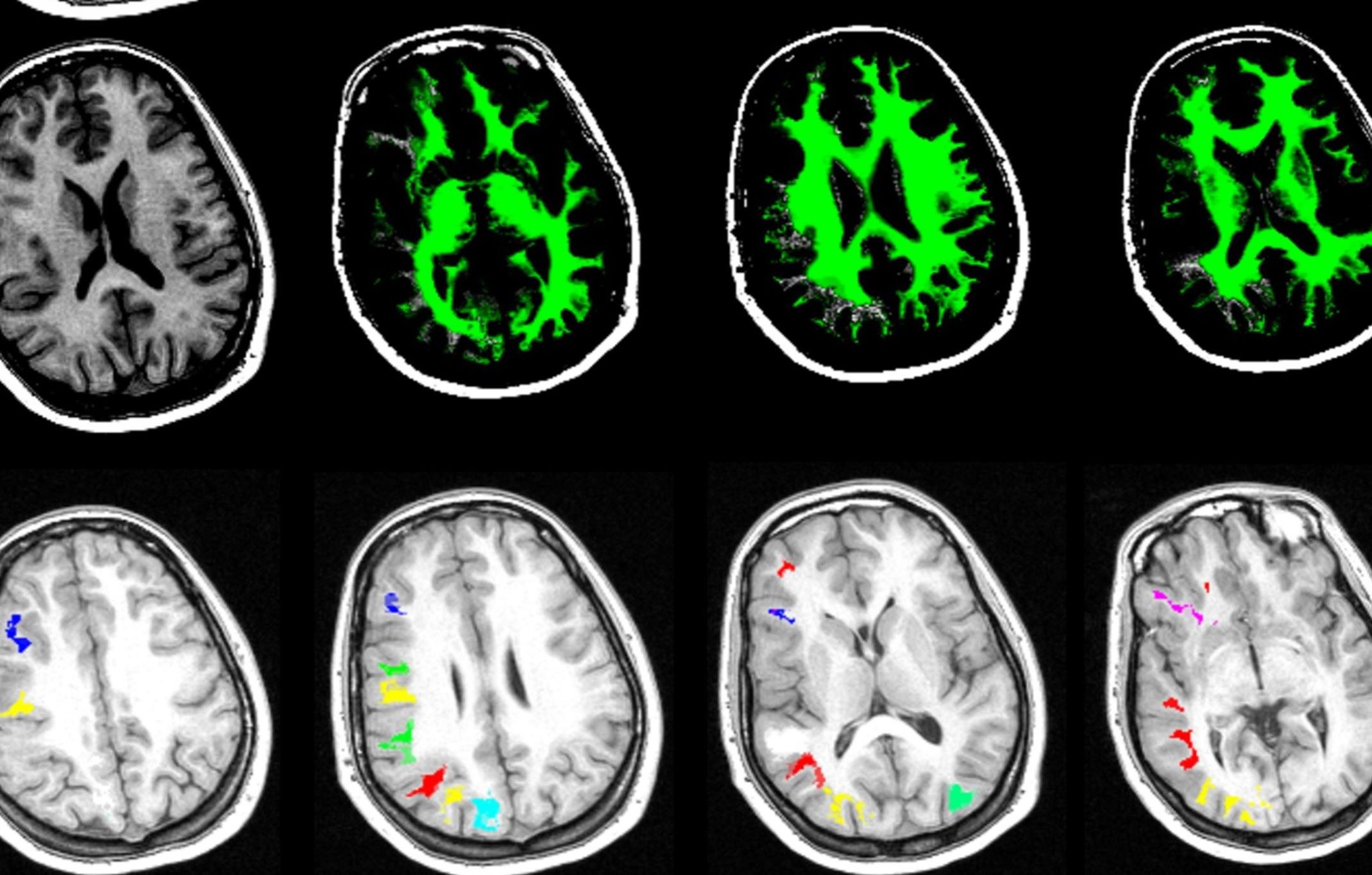 25-facts-about-subcortical-laminar-heterotopia