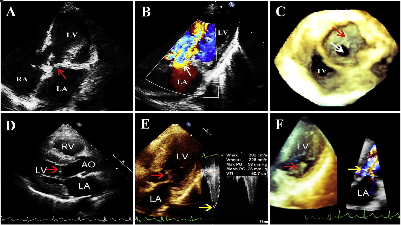 30-facts-about-congenital-mitral-malformation