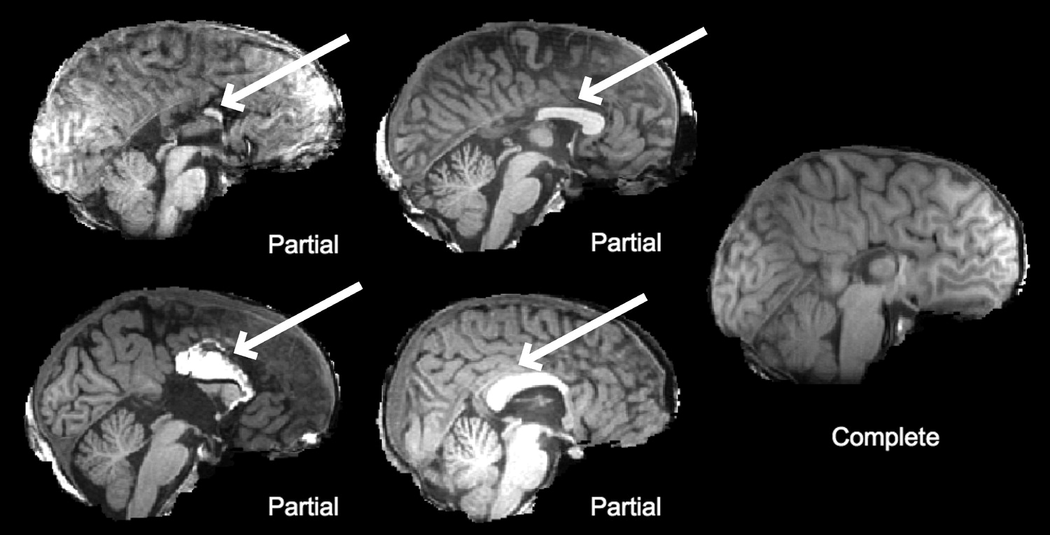 30-facts-about-corpus-callosum-dysgenesis