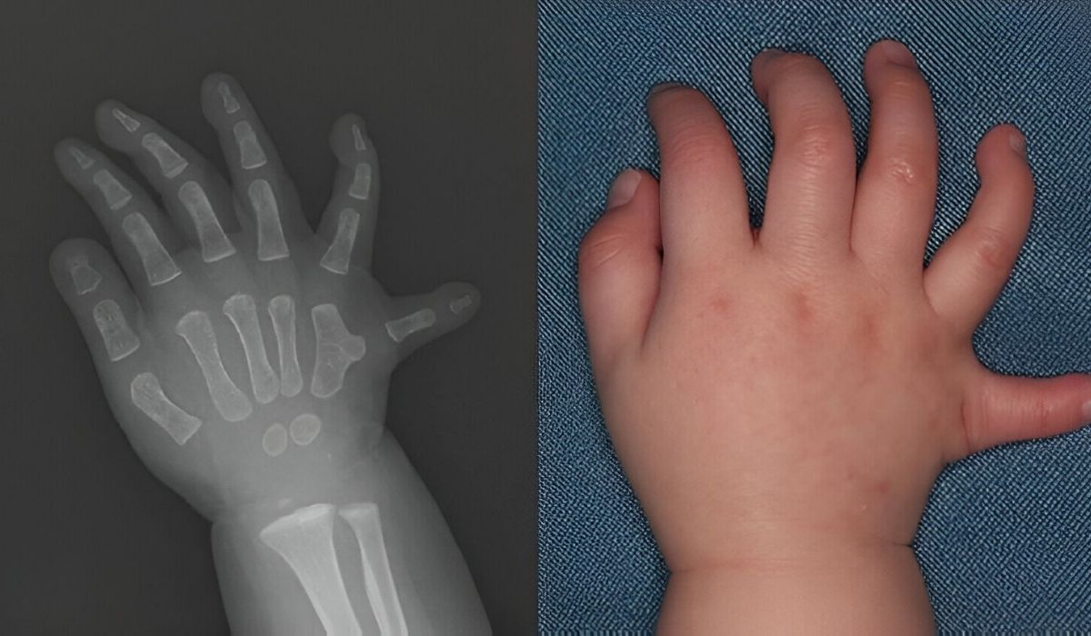 30 Facts About Polydactyly Preaxial Type 1 - Facts.net