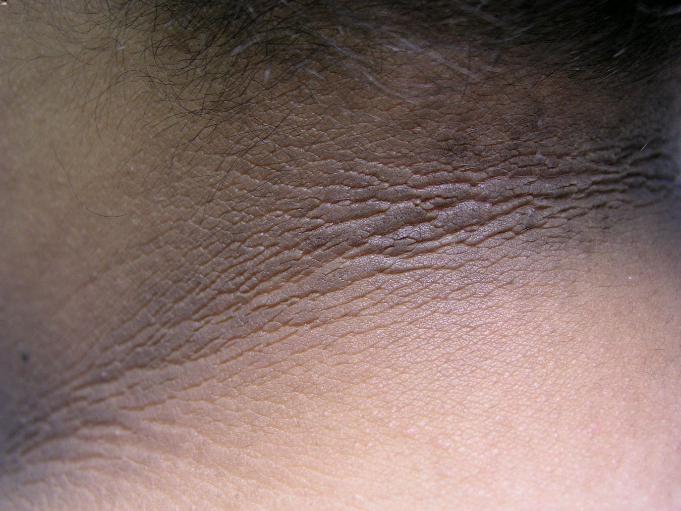 30-facts-about-cutis-gyratum-acanthosis-nigricans-craniosynostosis