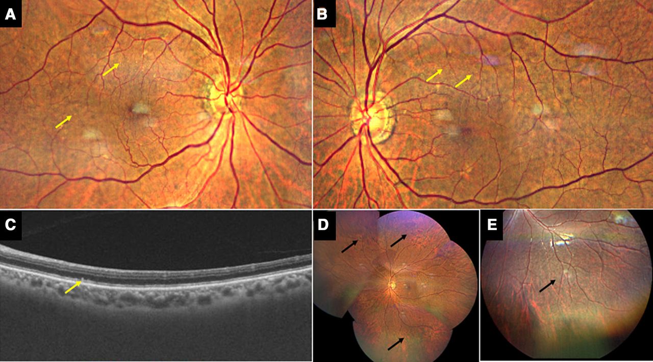 30-facts-about-doyne-honeycomb-retinal-dystrophy