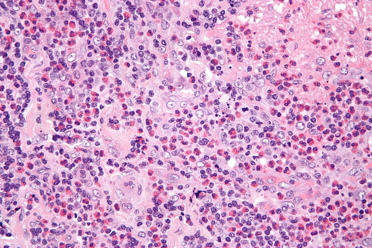 30-facts-about-eosinophilic-lymphogranuloma