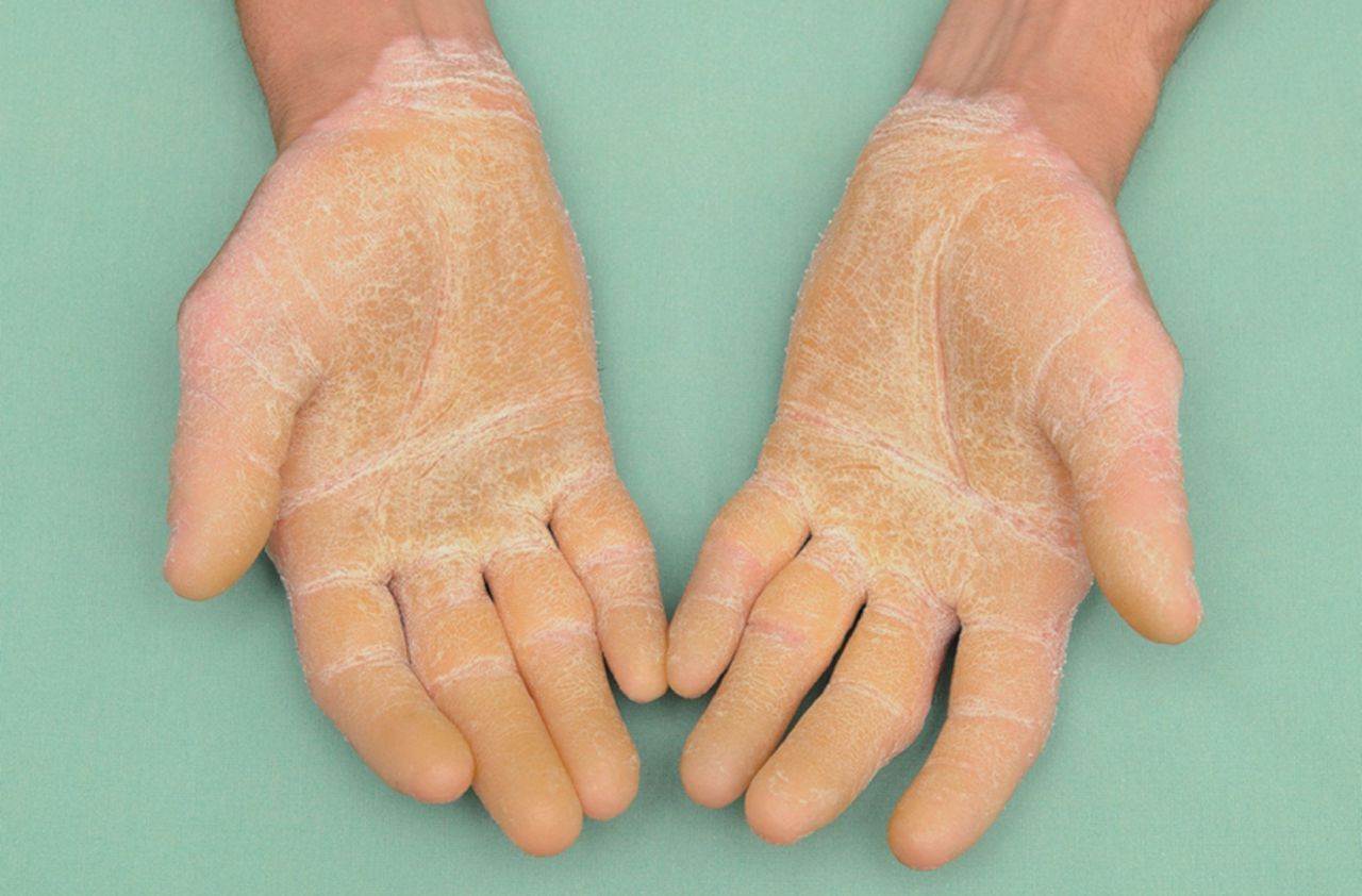 30-facts-about-epidermolytic-palmoplantar-keratoderma-vorner-type