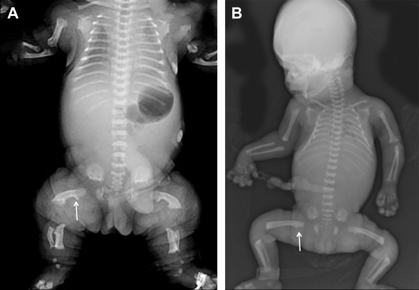 30-facts-about-epimetaphyseal-skeletal-dysplasia