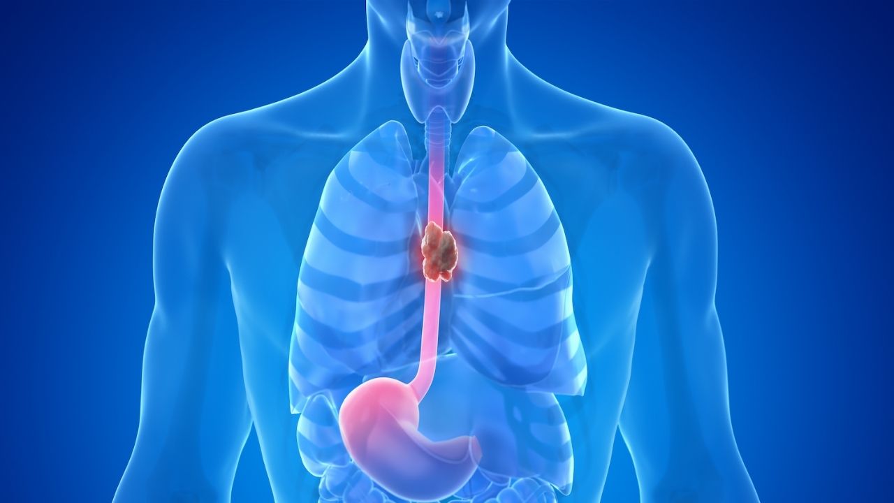 30-facts-about-esophageal-neoplasm