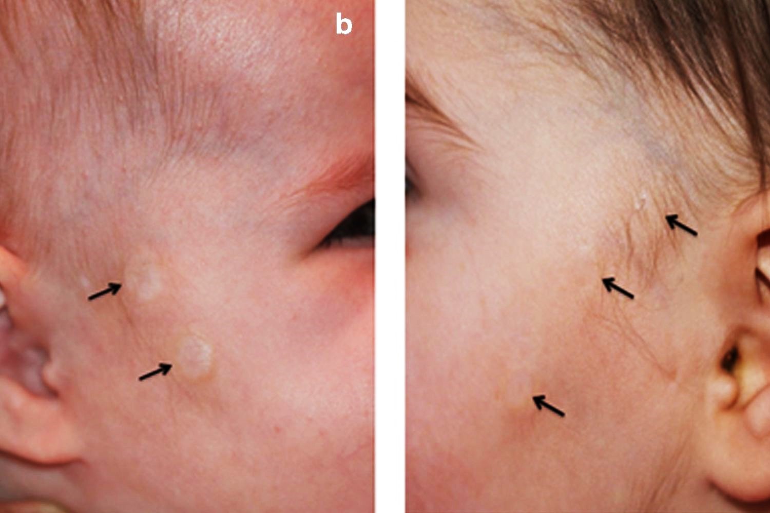 30-facts-about-focal-dermal-hypoplasia