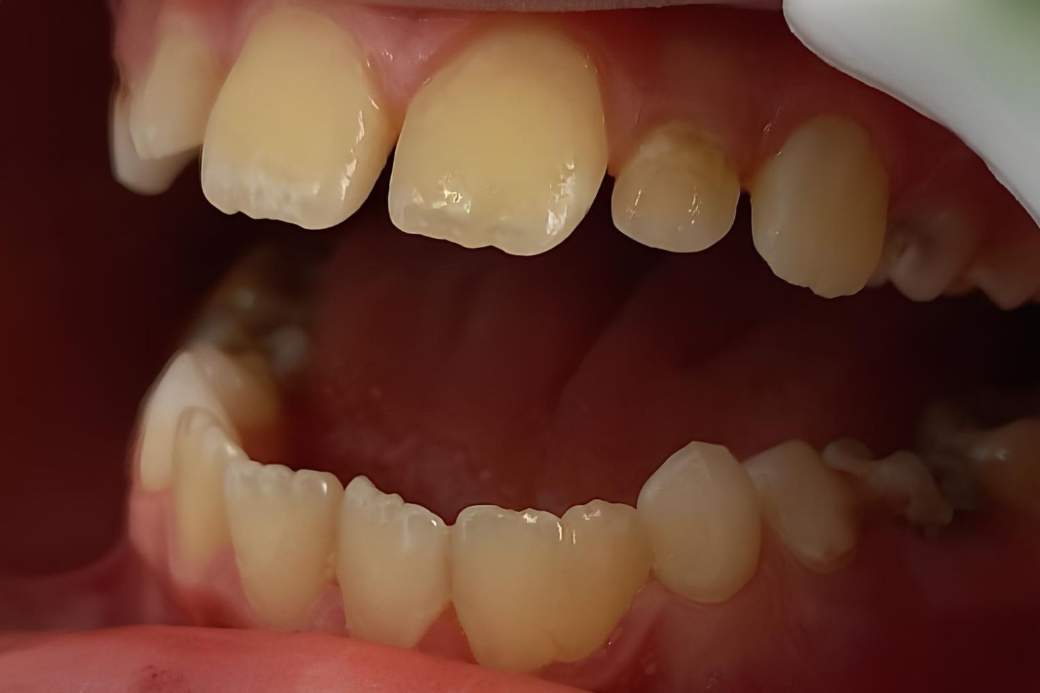 30-facts-about-fused-mandibular-incisors