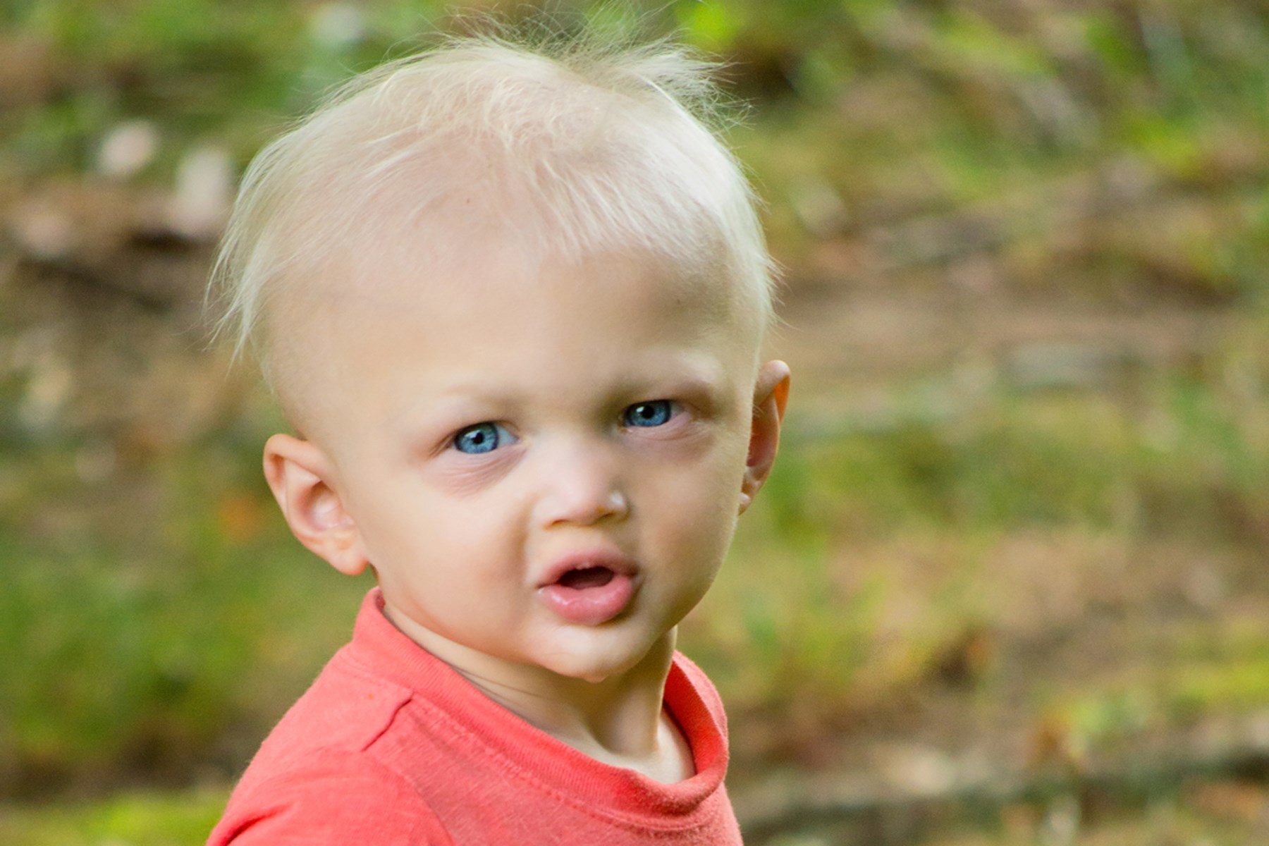 30-facts-about-hidrotic-ectodermal-dysplasia-christianson-fourie-type