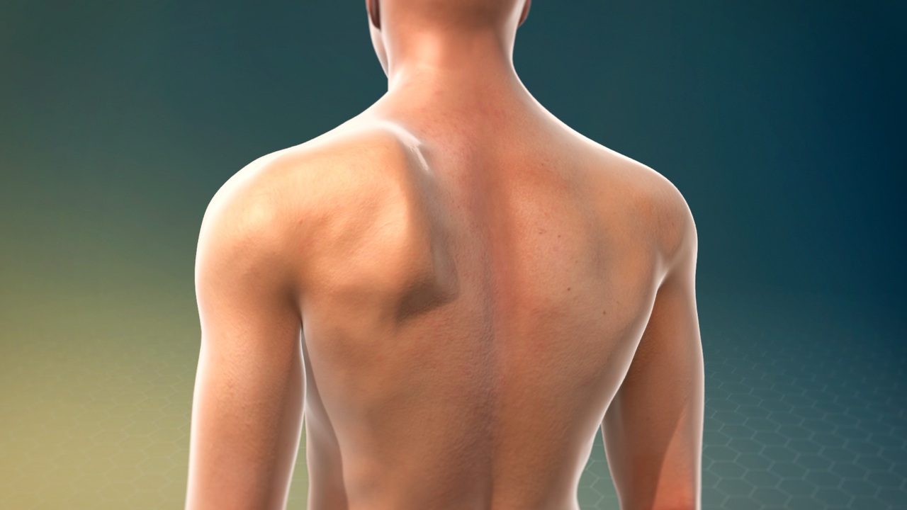 30-facts-about-high-scapula