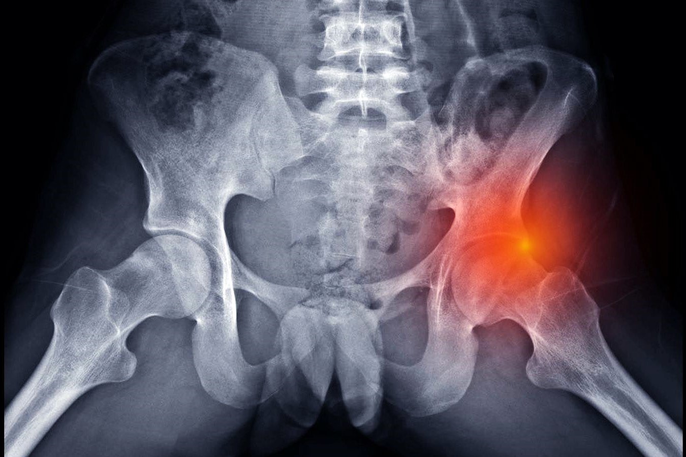 30-facts-about-hip-dysplasia-beukes-type