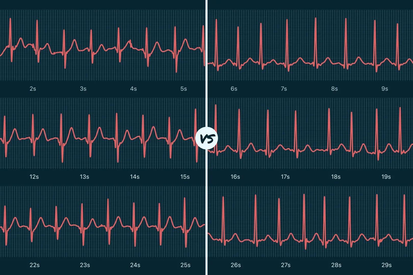 30-facts-about-his-bundle-tachycardia