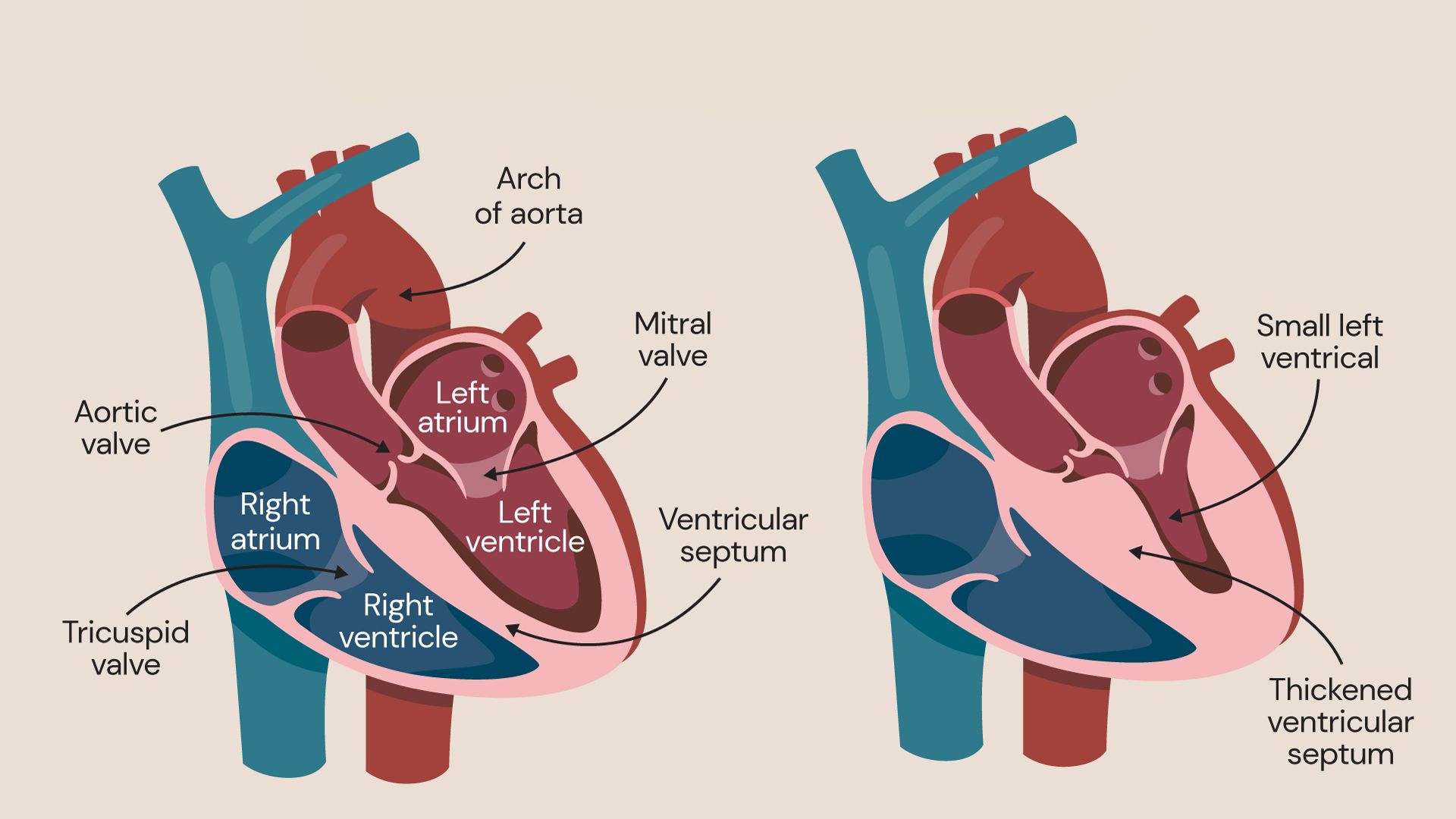 30-facts-about-hypertrophic-myocardiopathy