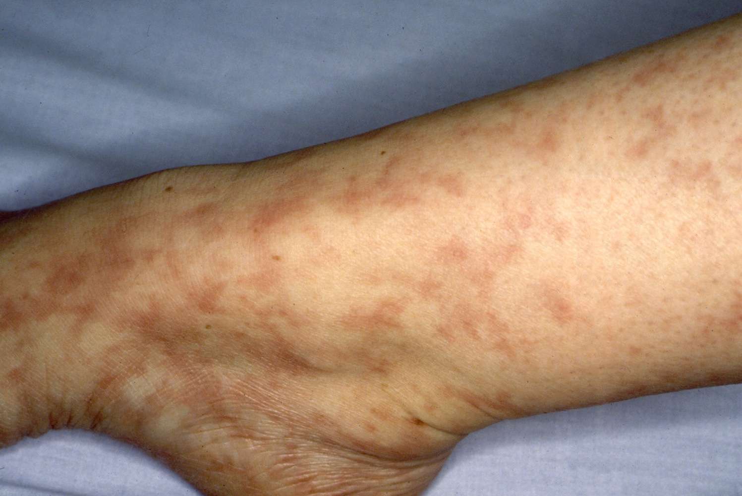 30-facts-about-livedoid-dermatitis