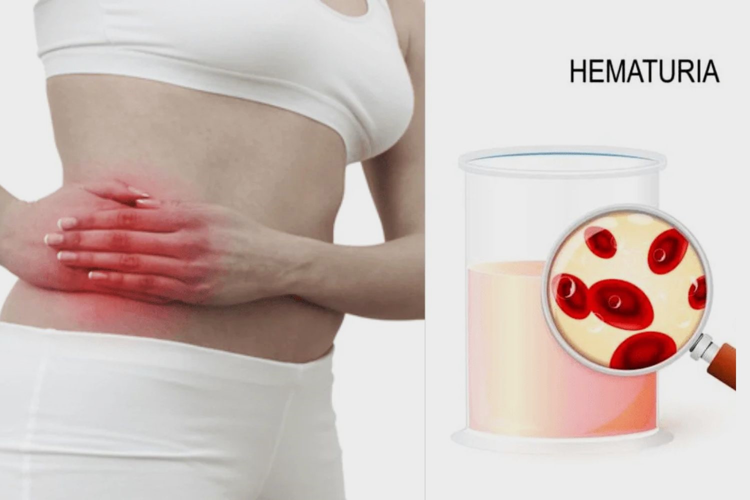 30-facts-about-loin-pain-hematuria