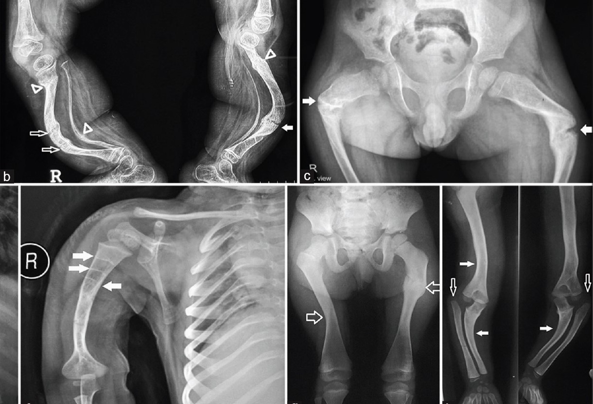 30-facts-about-malignant-infantile-osteopetrosis