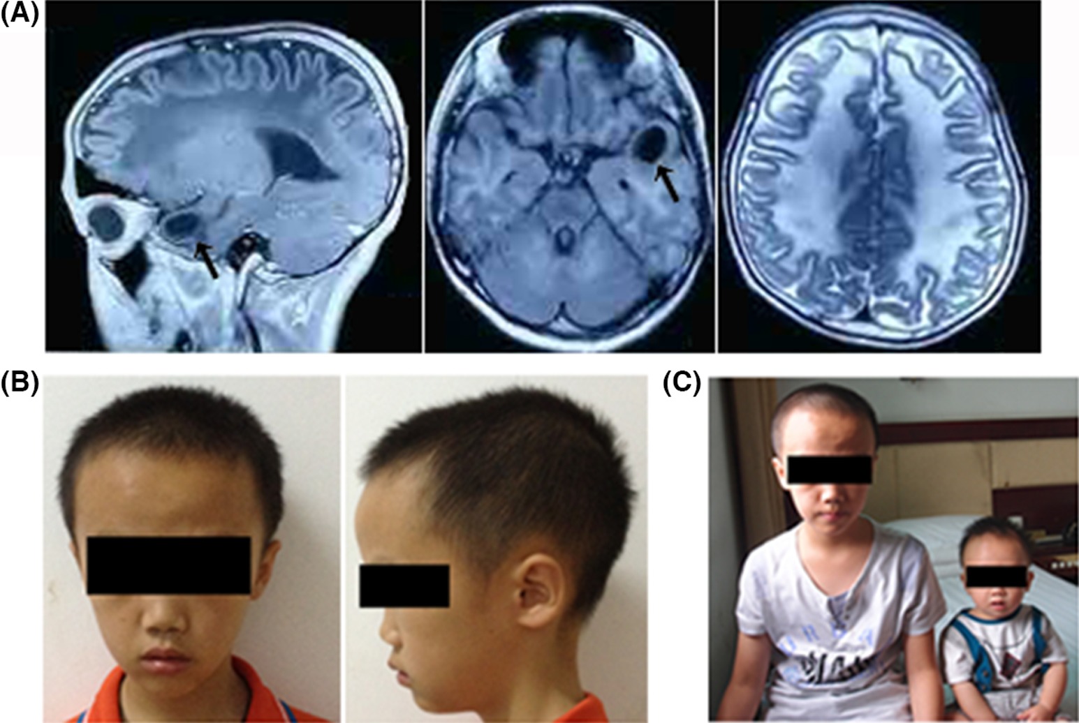 30-facts-about-megalencephalic-leukodystrophy