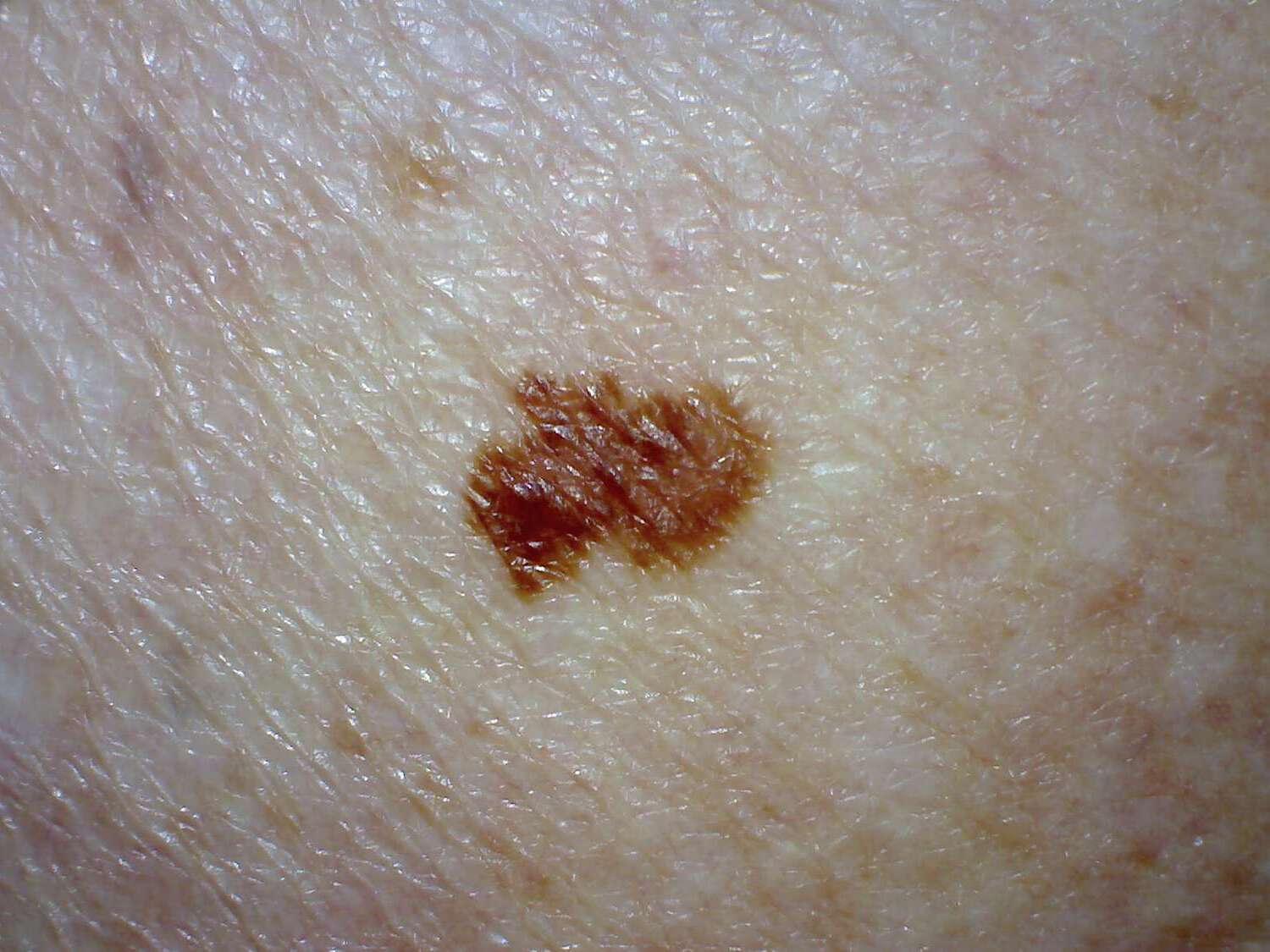 30-facts-about-melanoma-type-1