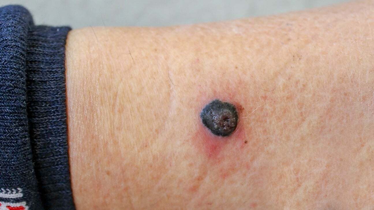 30-facts-about-melanoma-type-2