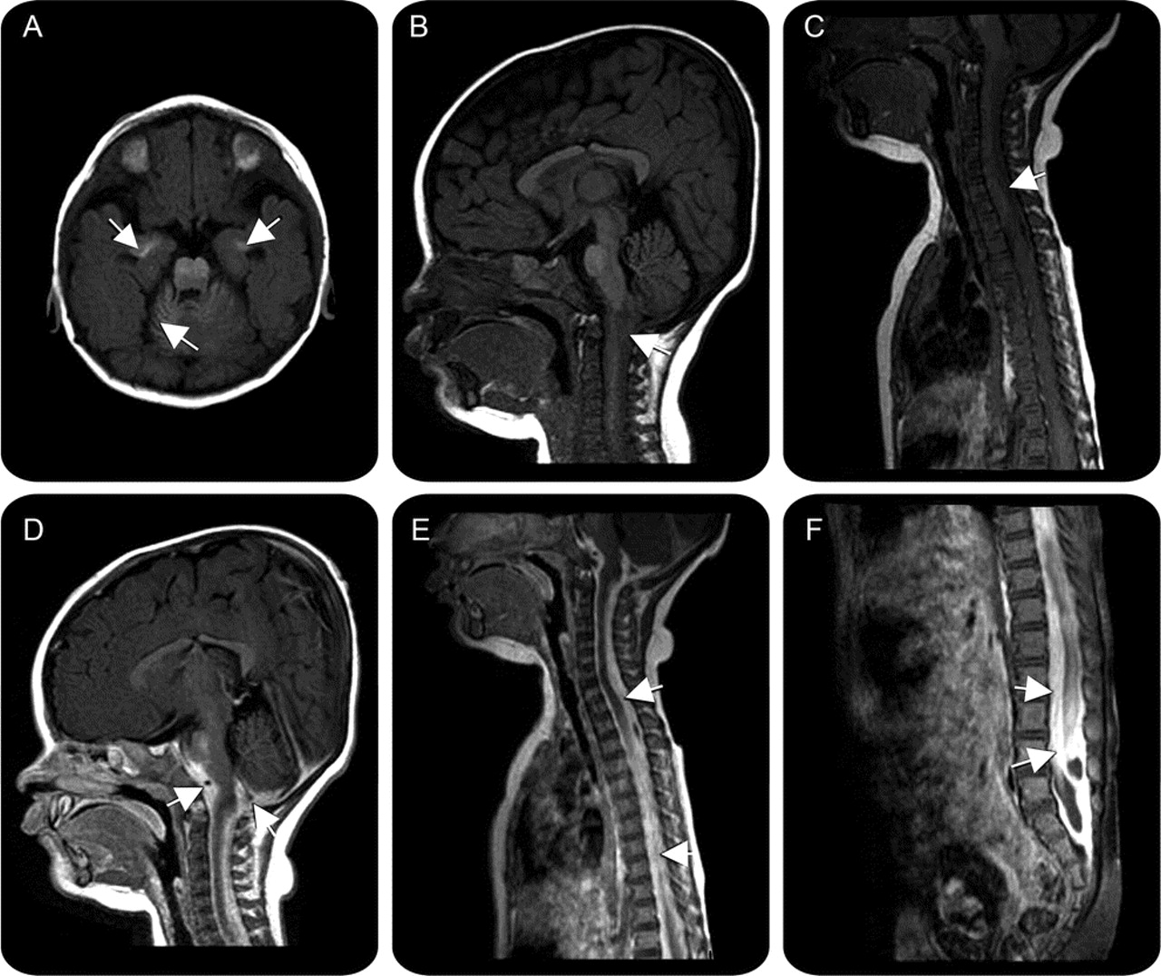 30-facts-about-melanosis-neurocutaneous