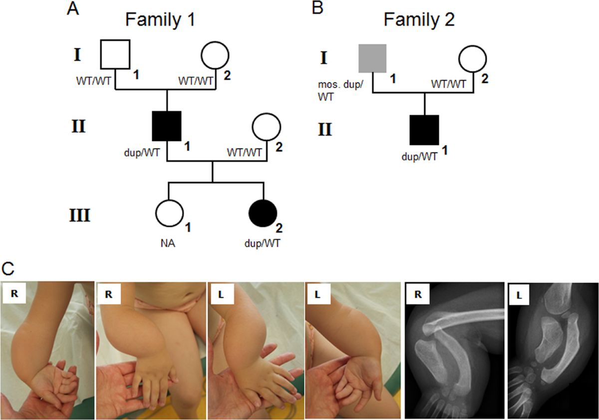 30-facts-about-mesomelic-dysplasia-thai-type