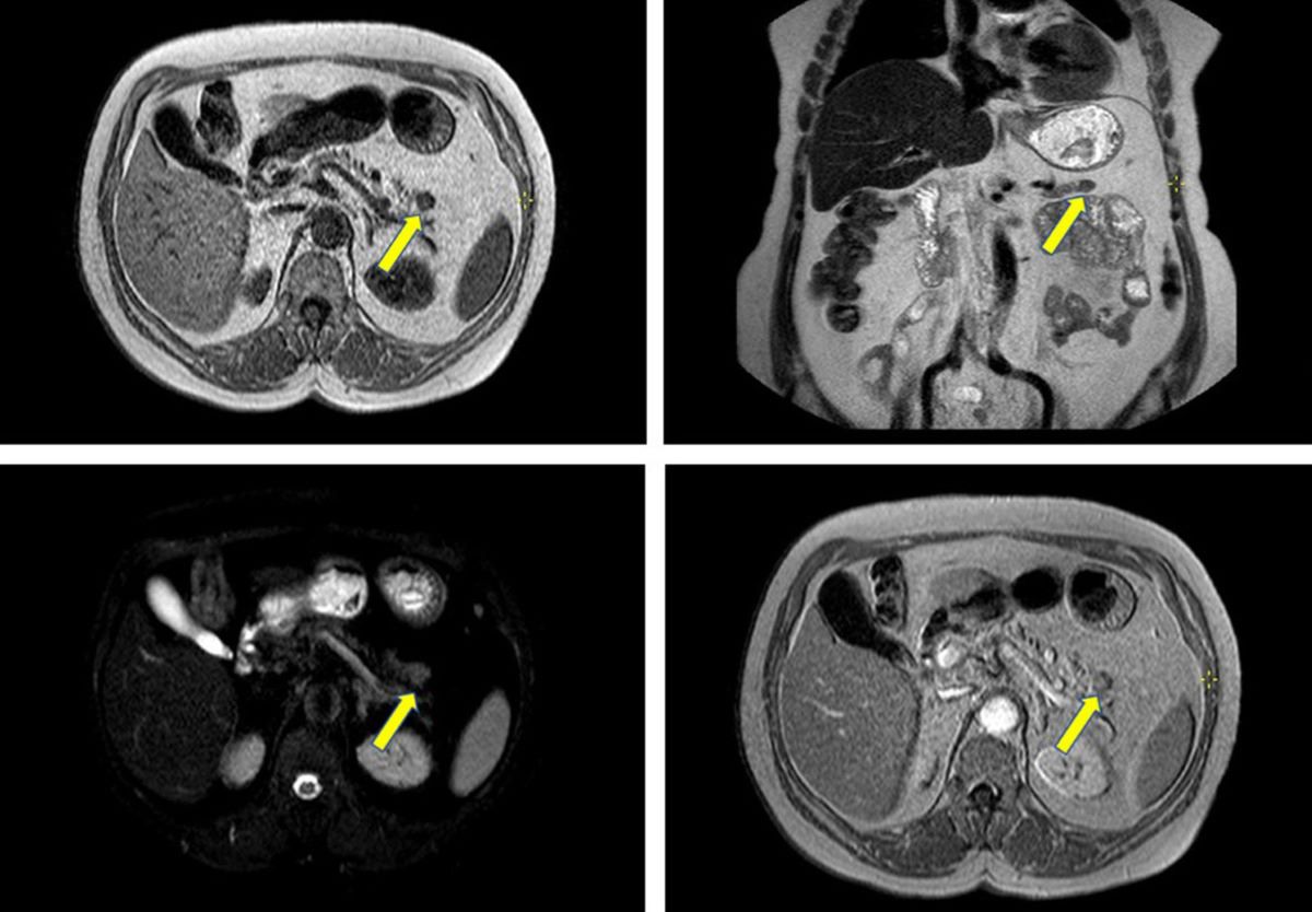 30-facts-about-metastatic-insulinoma