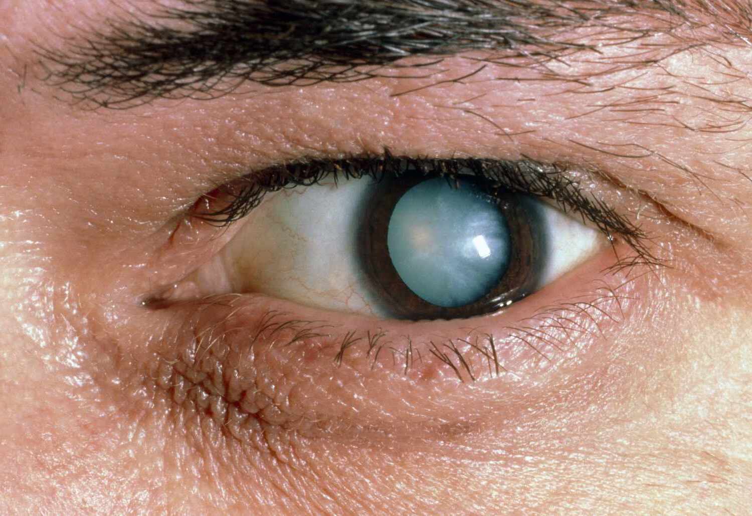 30-facts-about-methylmalonic-aciduria-microcephaly-cataract