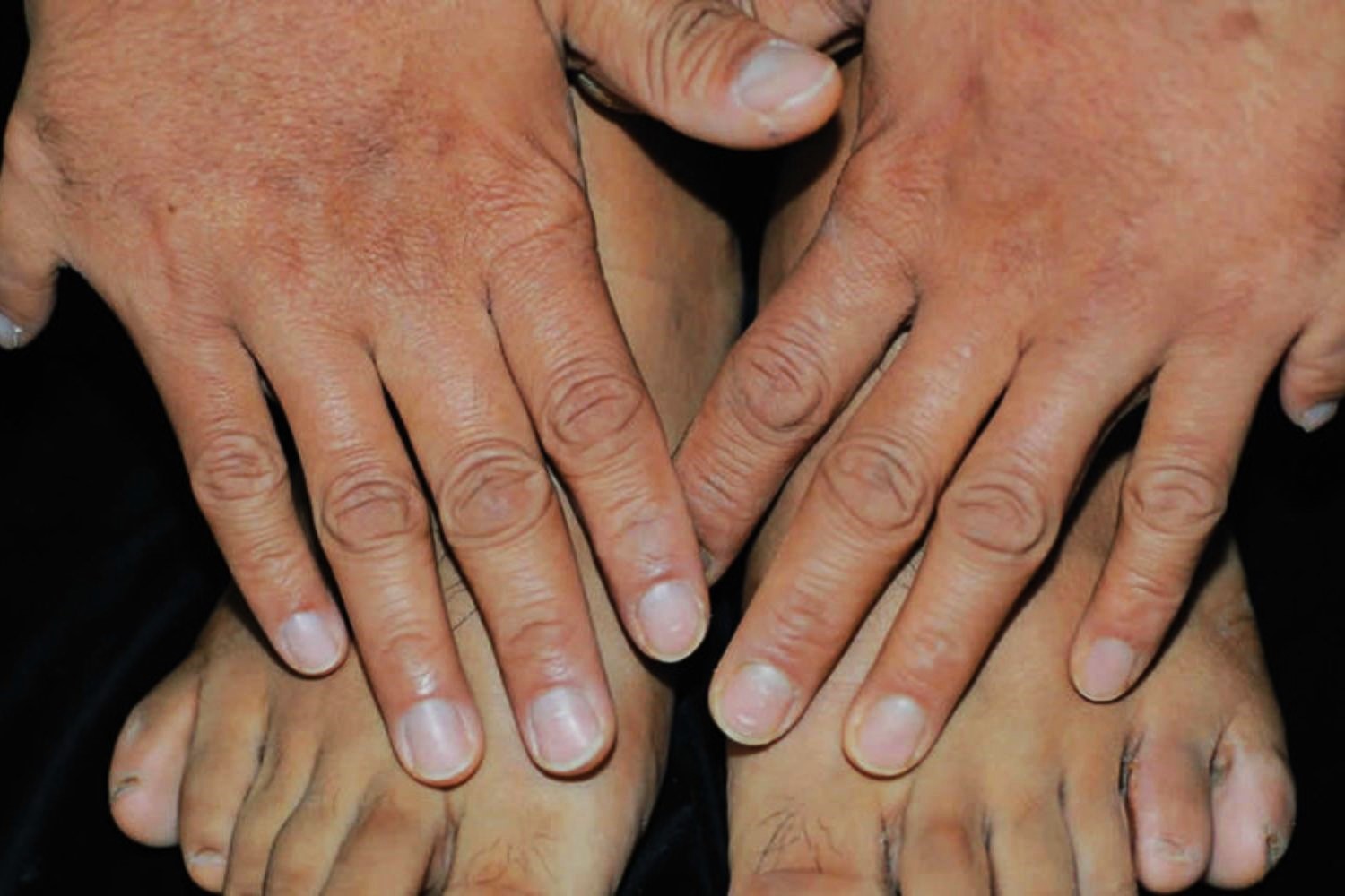 30-facts-about-mullerian-derivatives-lymphangiectasia-polydactyly