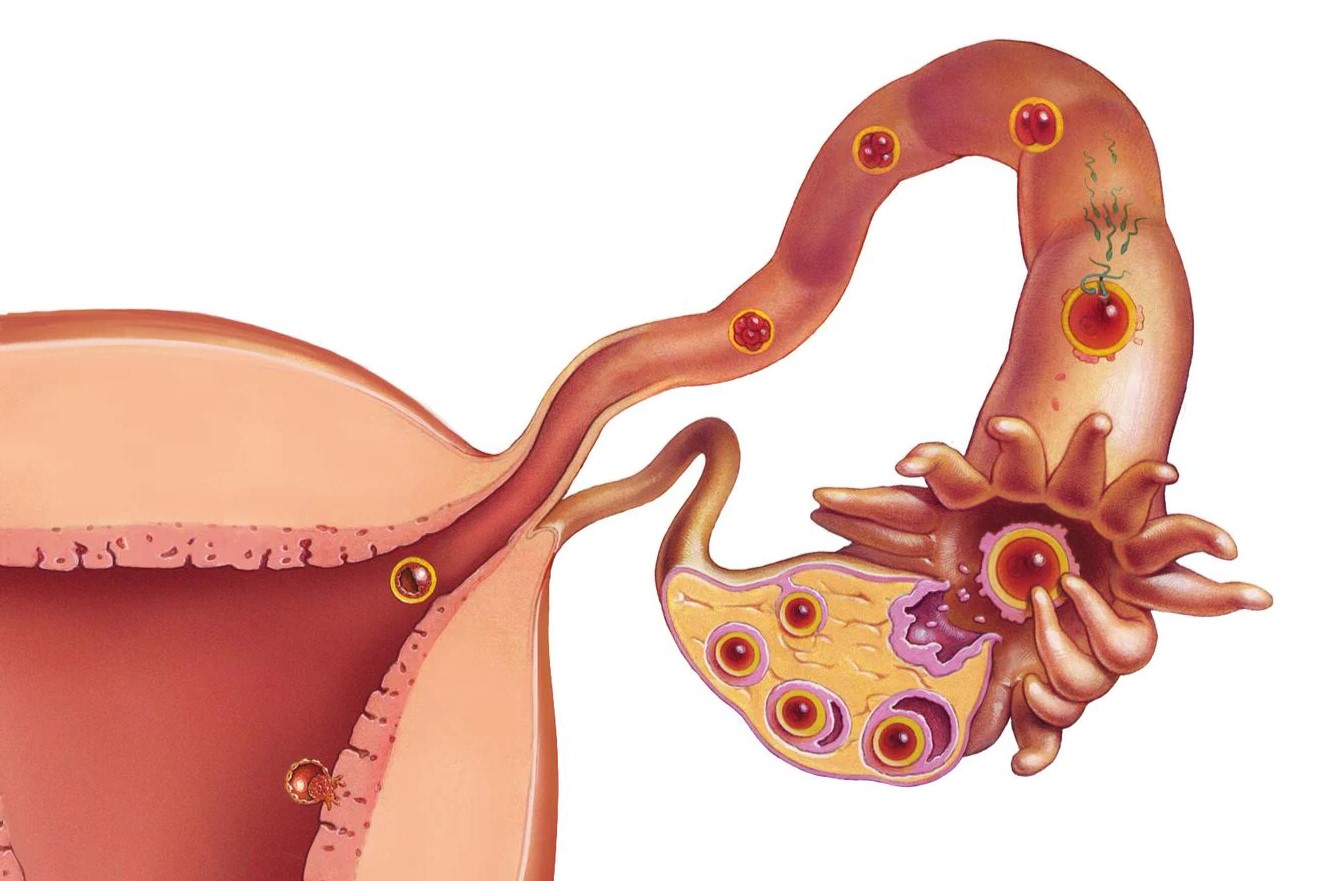 30-facts-about-mullerian-duct-abnormalities-galactosemia
