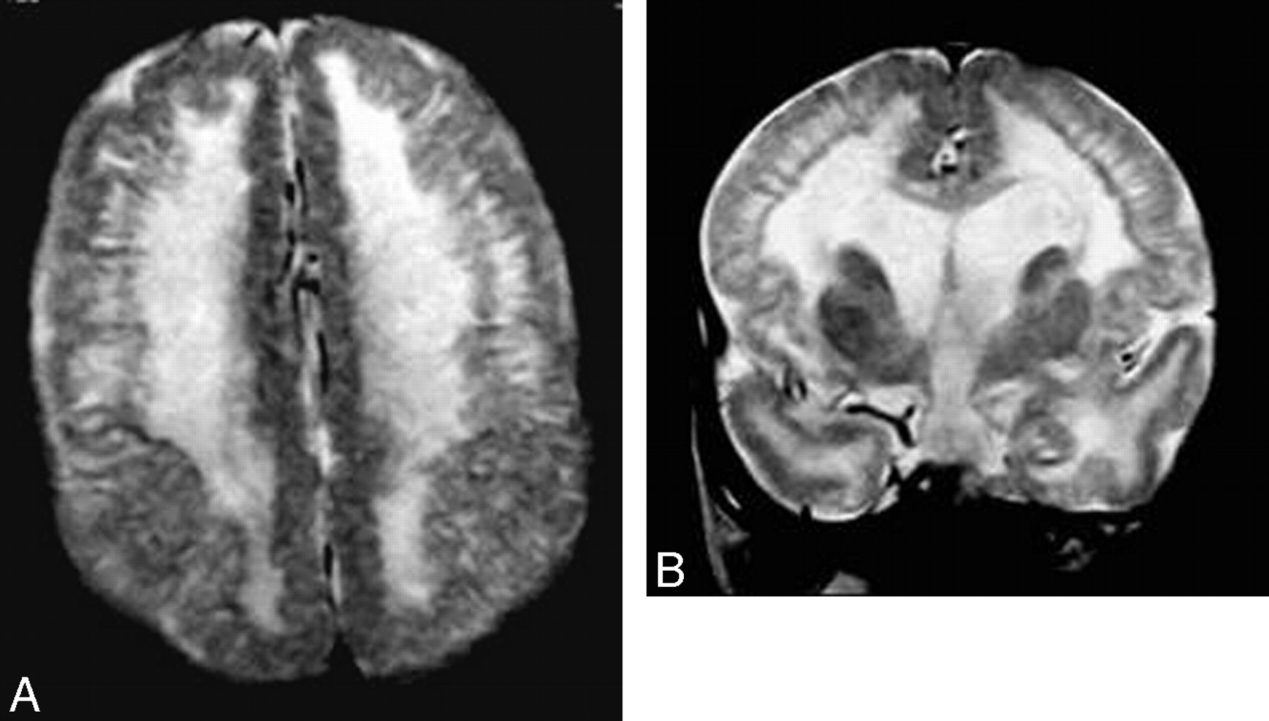 30 Facts About Non-Lissencephalic Cortical Dysplasia - Facts.net