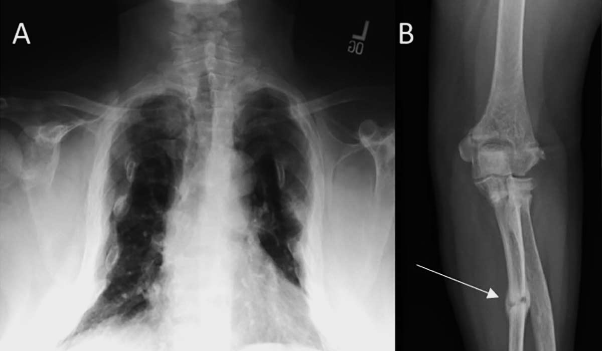 30-facts-about-oncogenic-osteomalacia