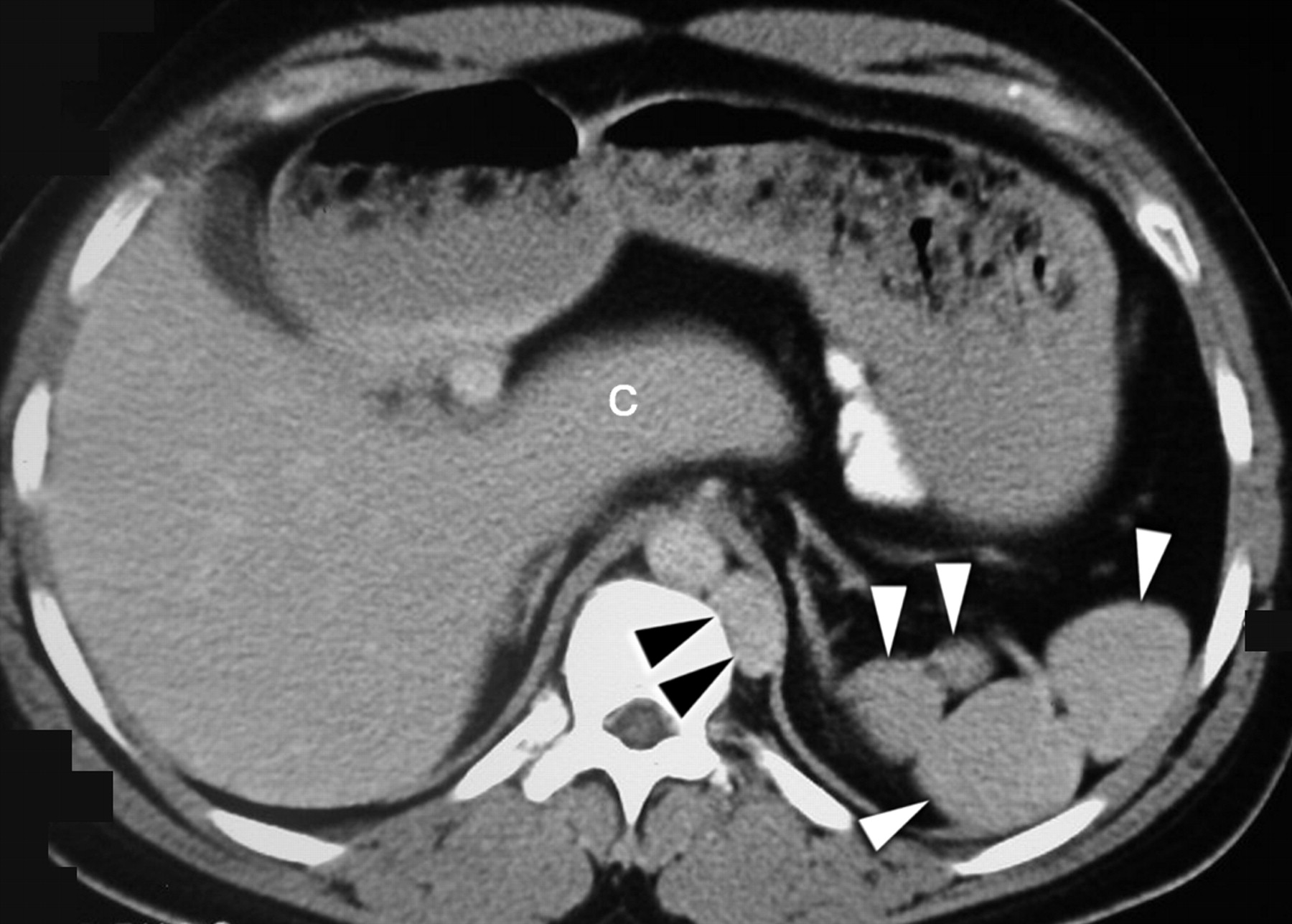 30-facts-about-pancreas-agenesis