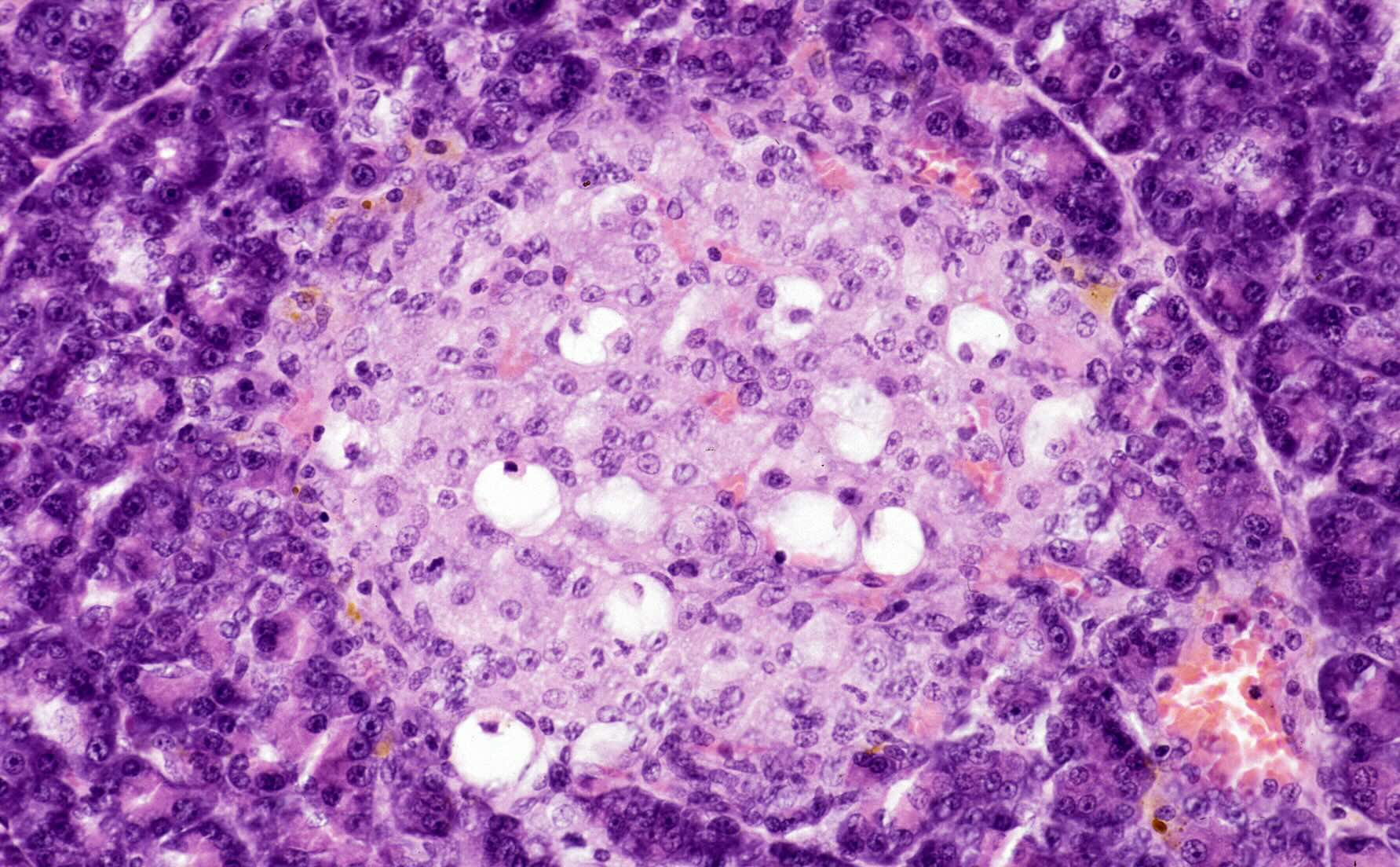 30-facts-about-pancreatic-islet-cell-neoplasm