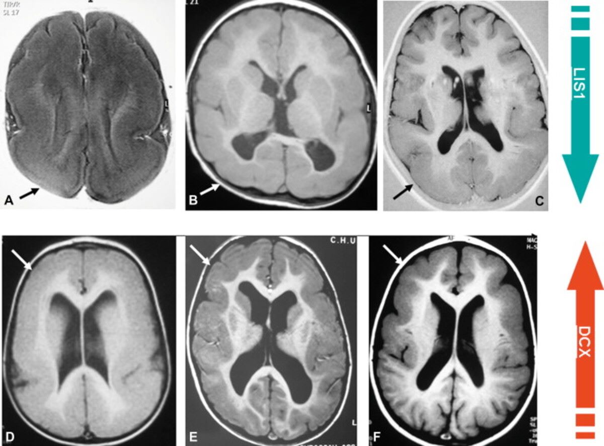 30-facts-about-partial-lissencephaly