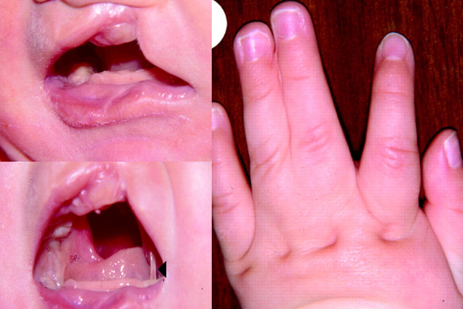 30-facts-about-polydactyly-cleft-lip-palate-psychomotor-retardation